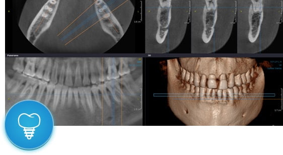Имплантация зубов по технологии 3D